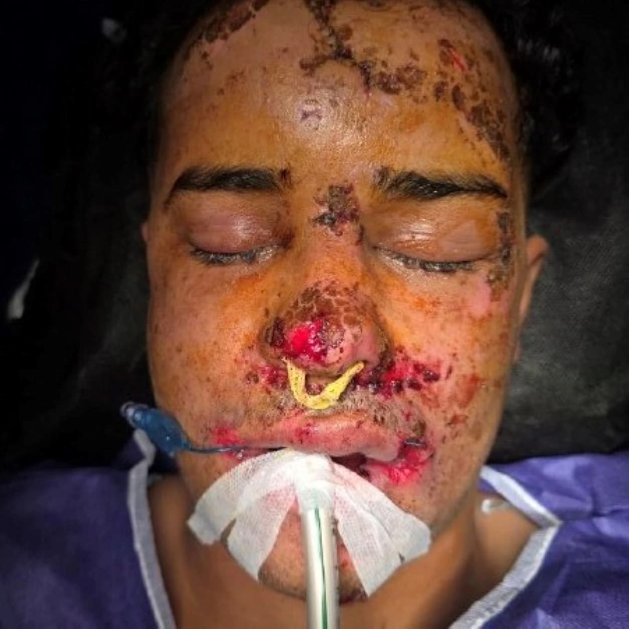 بازسازی نواقص صورت — مورد 1 — قبل